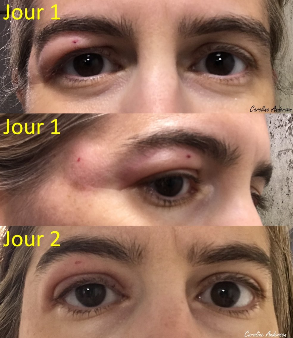 Piqure_Simuliidae_Jour1-2